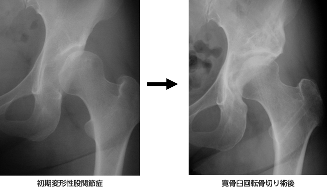 １）寛骨臼回転骨切り術