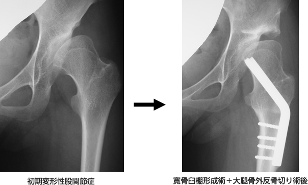２）寛骨臼棚形成術