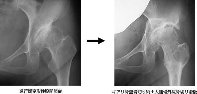 ３）キアリ骨盤骨切り術
