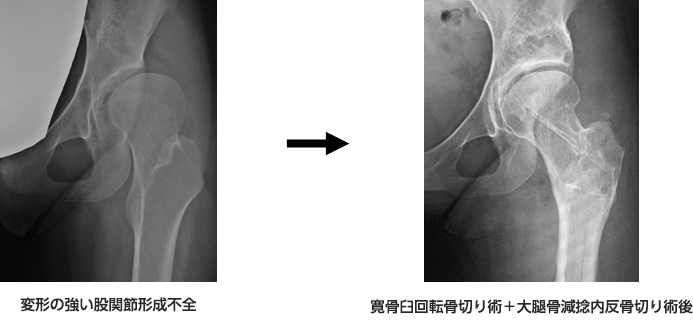 ４）骨盤骨切り術と大腿骨骨切り術の組み合わせ