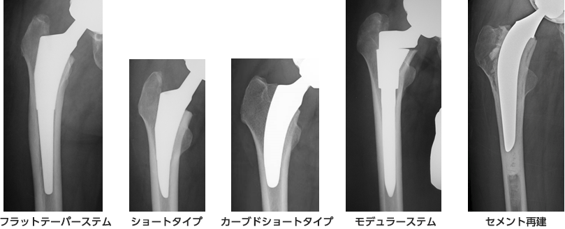人工股関節置換術について